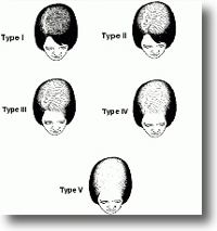womenhairlossscale